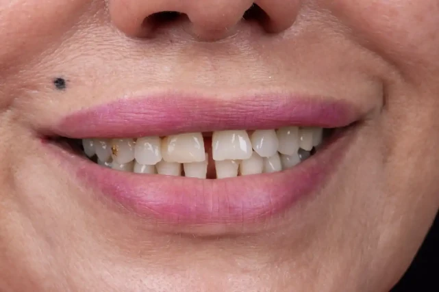 Nachher Porzellan-Zahnveneer Tunesien – weißes und gleichmäßiges Lächeln Ergebnis VIP Smile